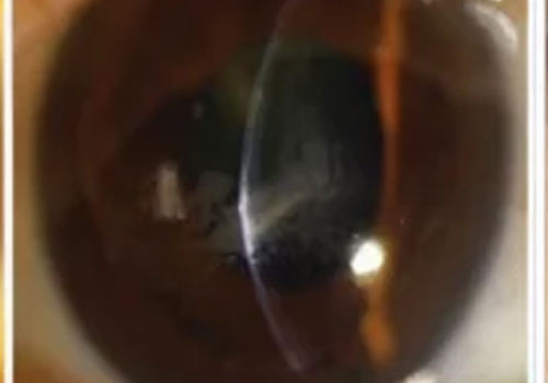 精彩疑例丨LASIK术后并发症角膜瓣下上皮植入的治疗策略